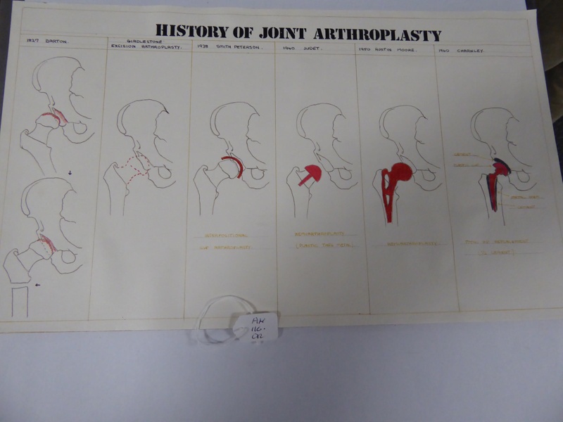 History of hip arthroplasty; AMP.116.OR eHive
